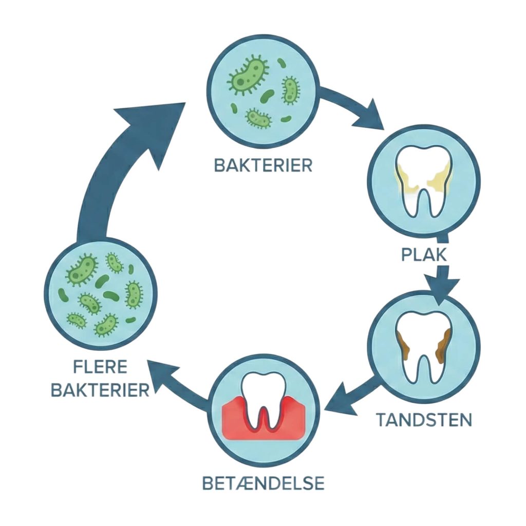 Cirkeldiagram af mundhygiejne: bakterier → plak → tandsten → betændelse → flere bakterier