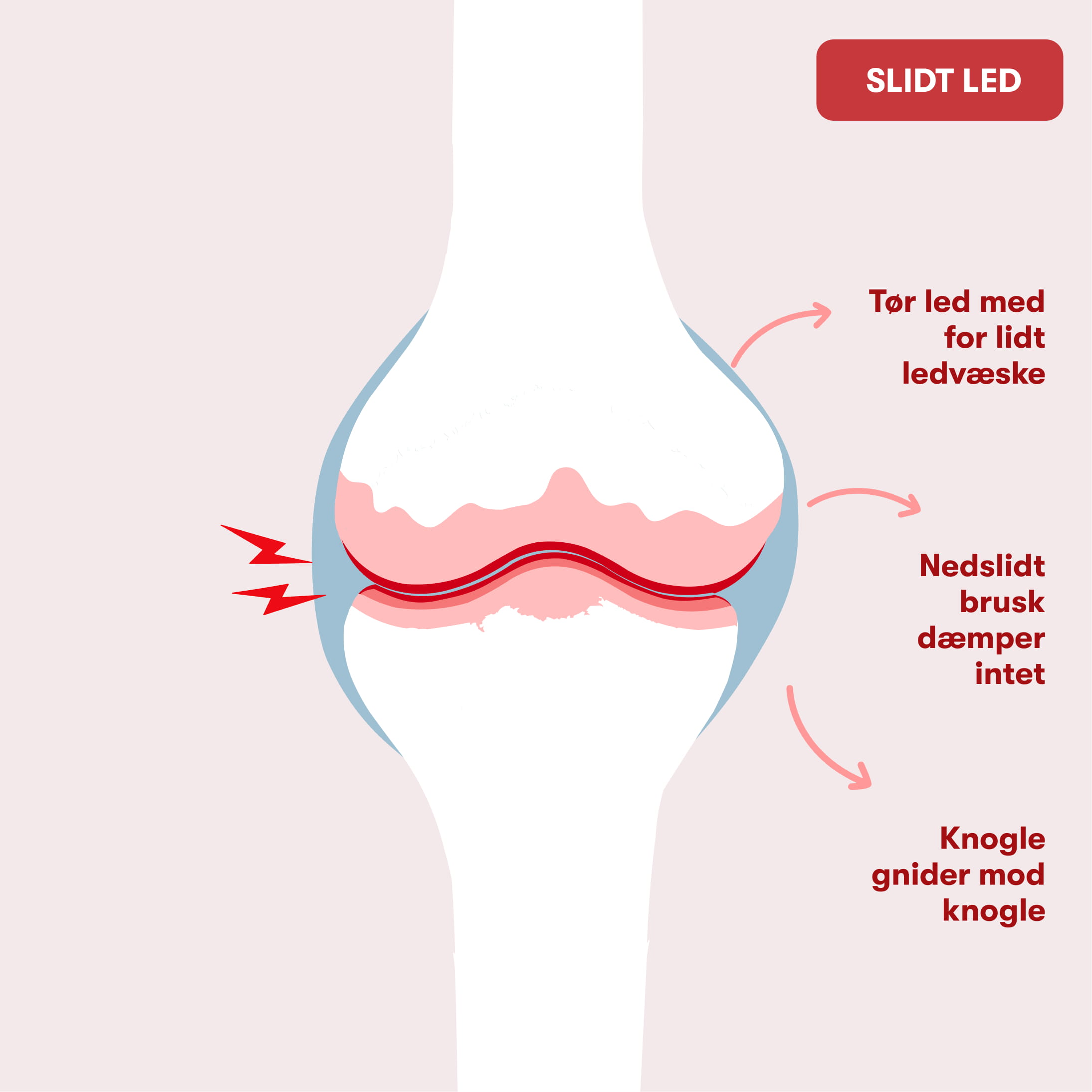 Diagram af knæled med nedslidt brusk, reduceret ledvæske og røde smerteindikatorer